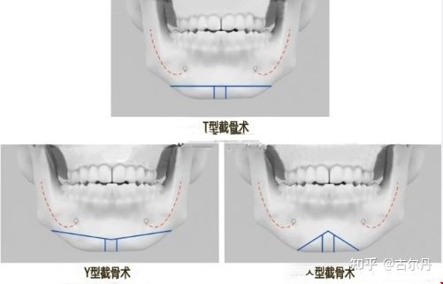 截骨头示意图.jpg